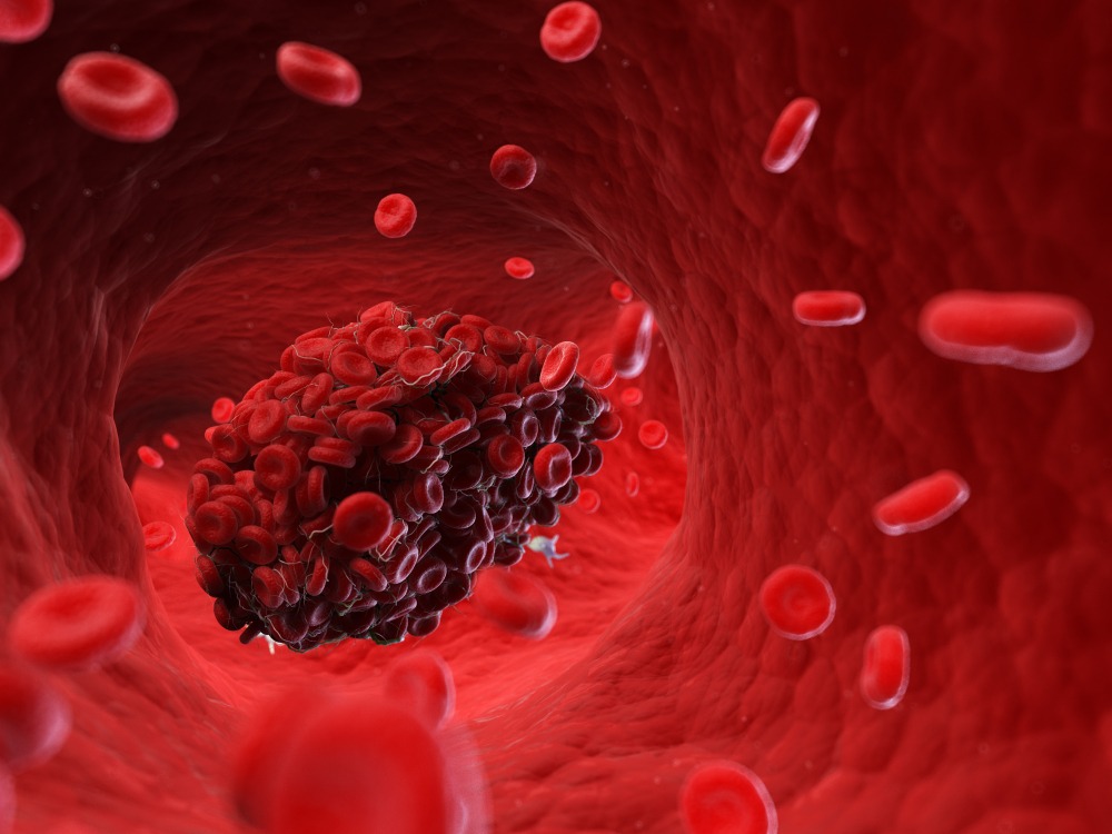 What Causes Blood Clots? 11 Things That Can Raise Your Risk